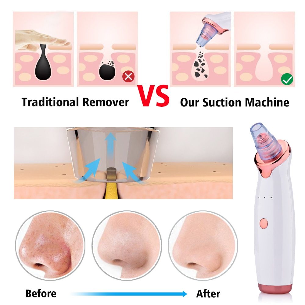 BuzzNest Electric Blackhead Remover | Deep Pore Suction & Skin Rejuvenation
