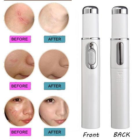 BuzzNest Blue Light Therapy Acne Pen | Scar & Wrinkle Removal Device